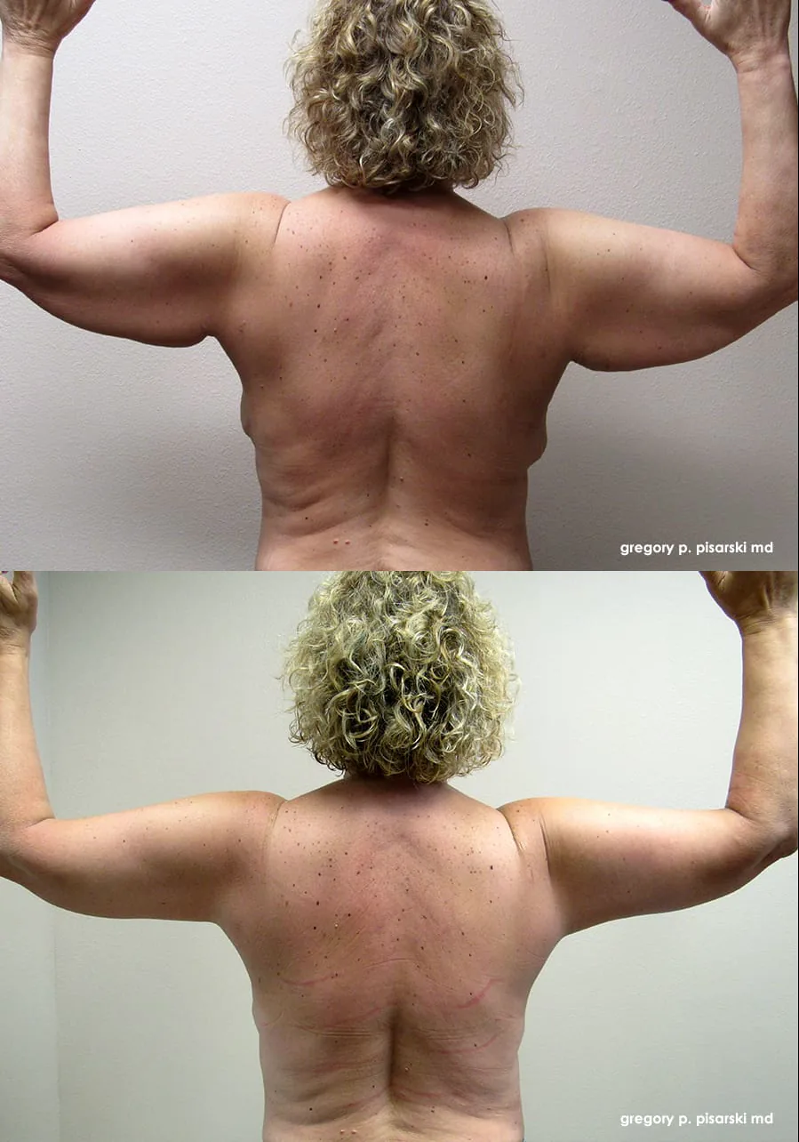 Brachioplasty patient