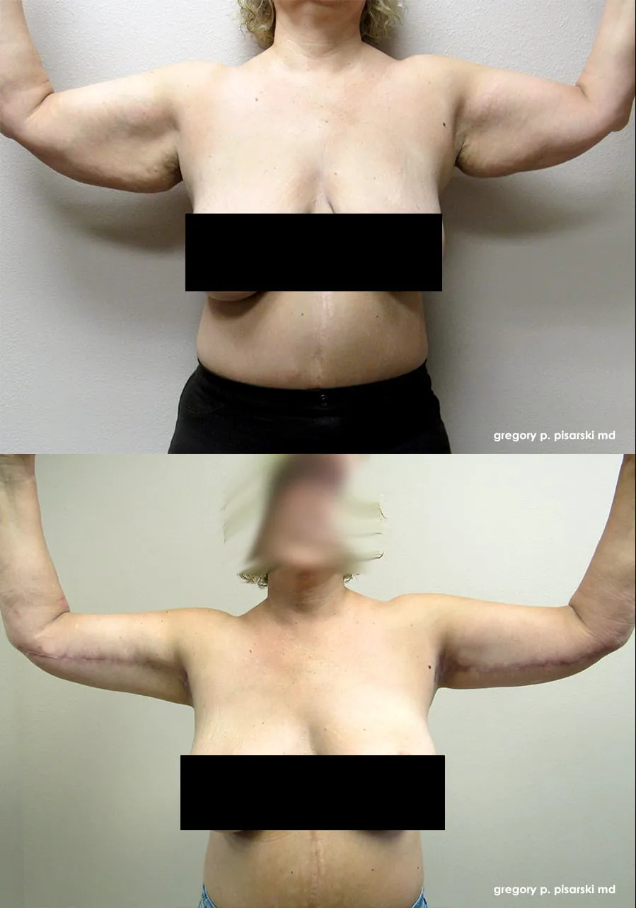 Brachioplasty patient