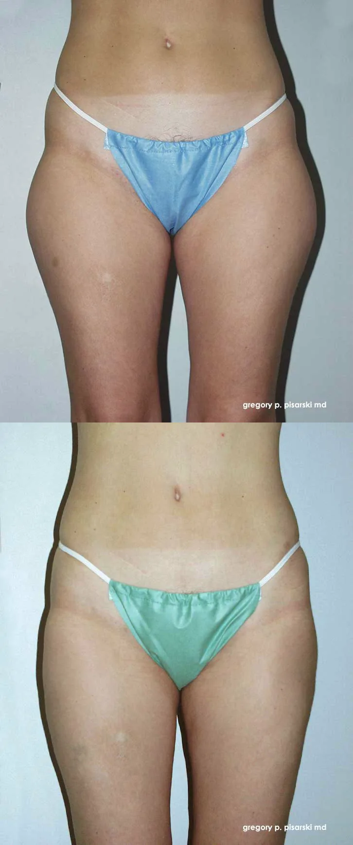 Liposuction patient