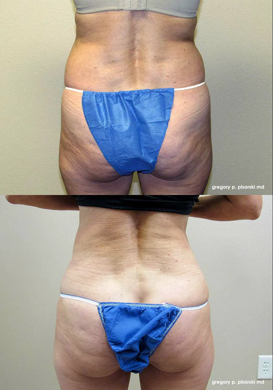 SmartLipo patient