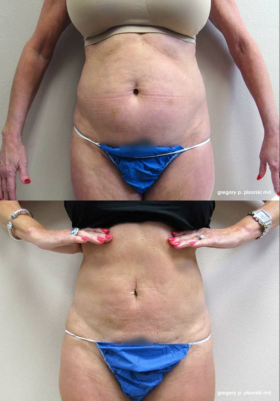 SmartLipo patient