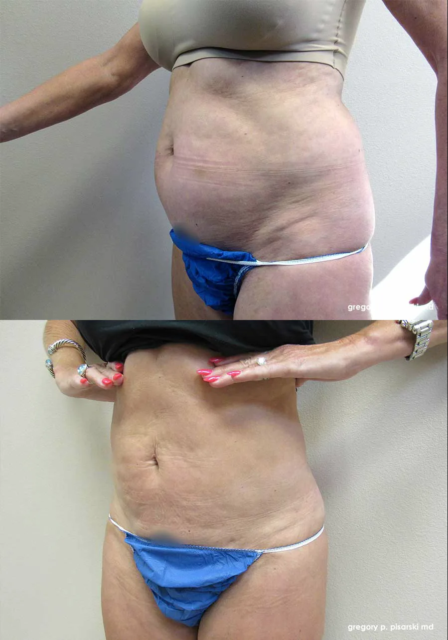 SmartLipo patient