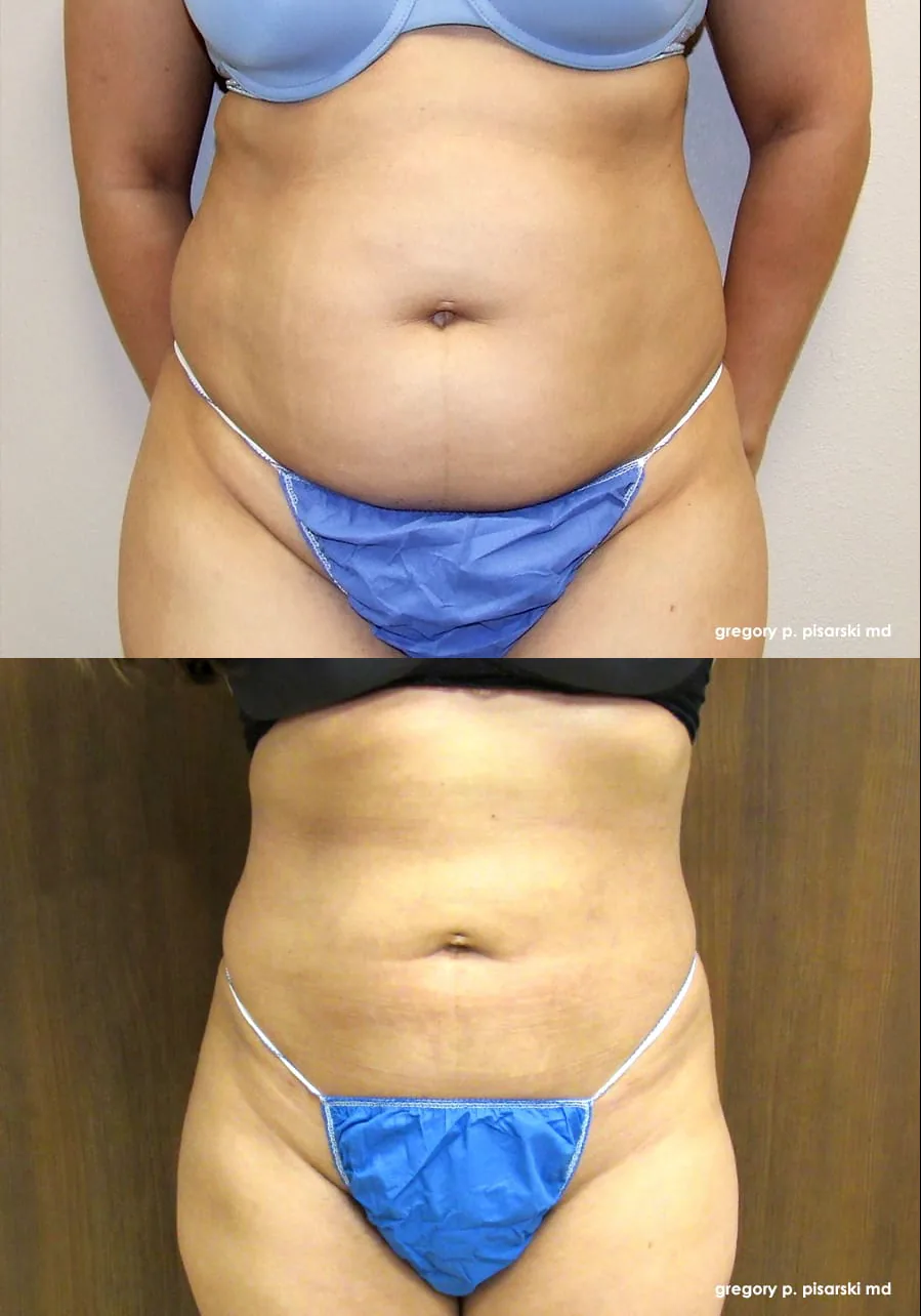 SmartLipo patient