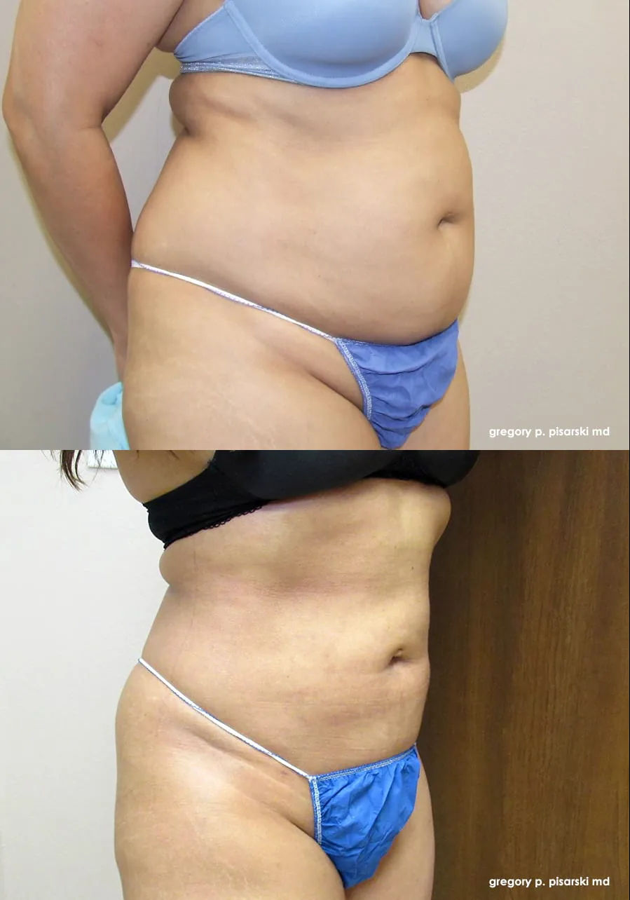 SmartLipo patient
