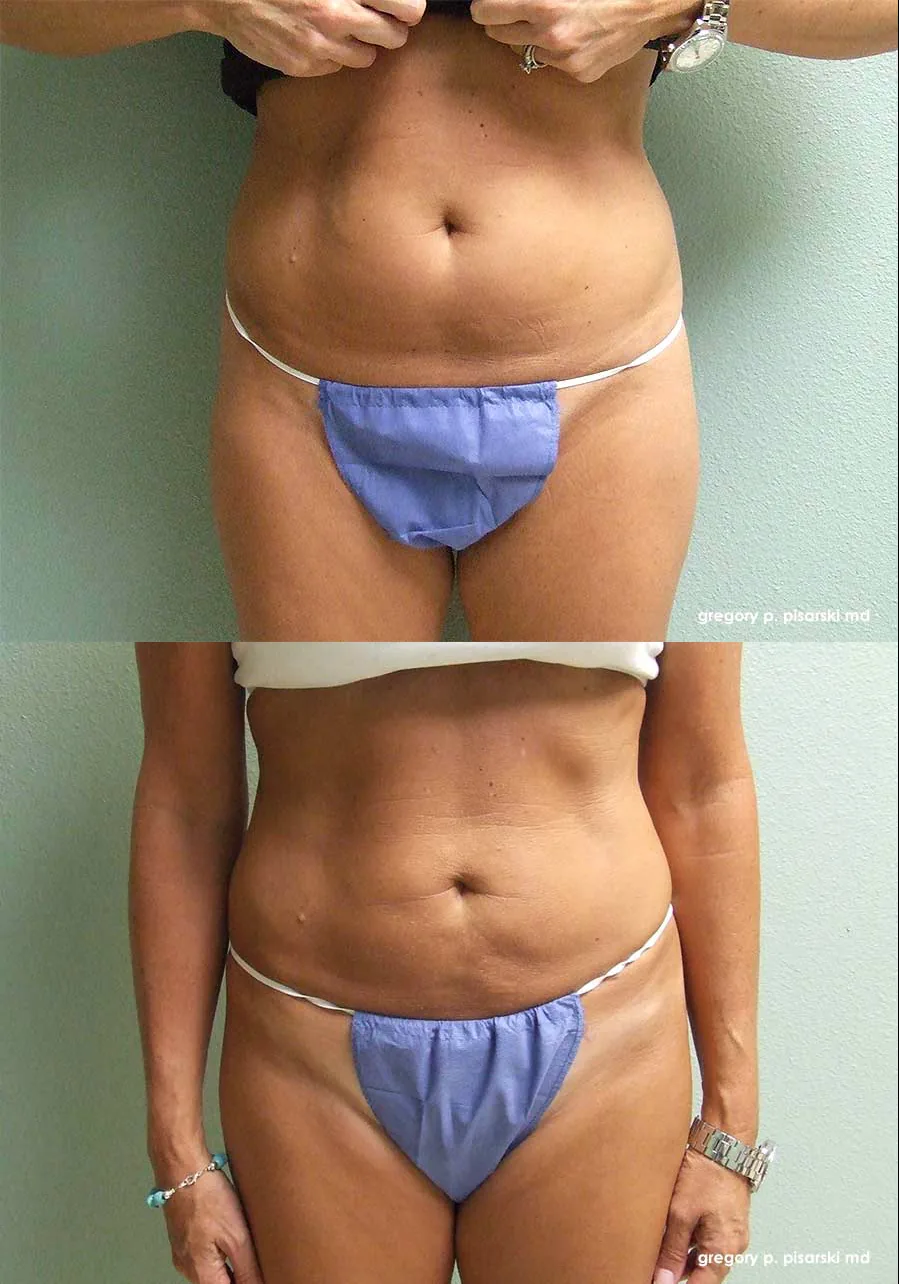 SmartLipo patient