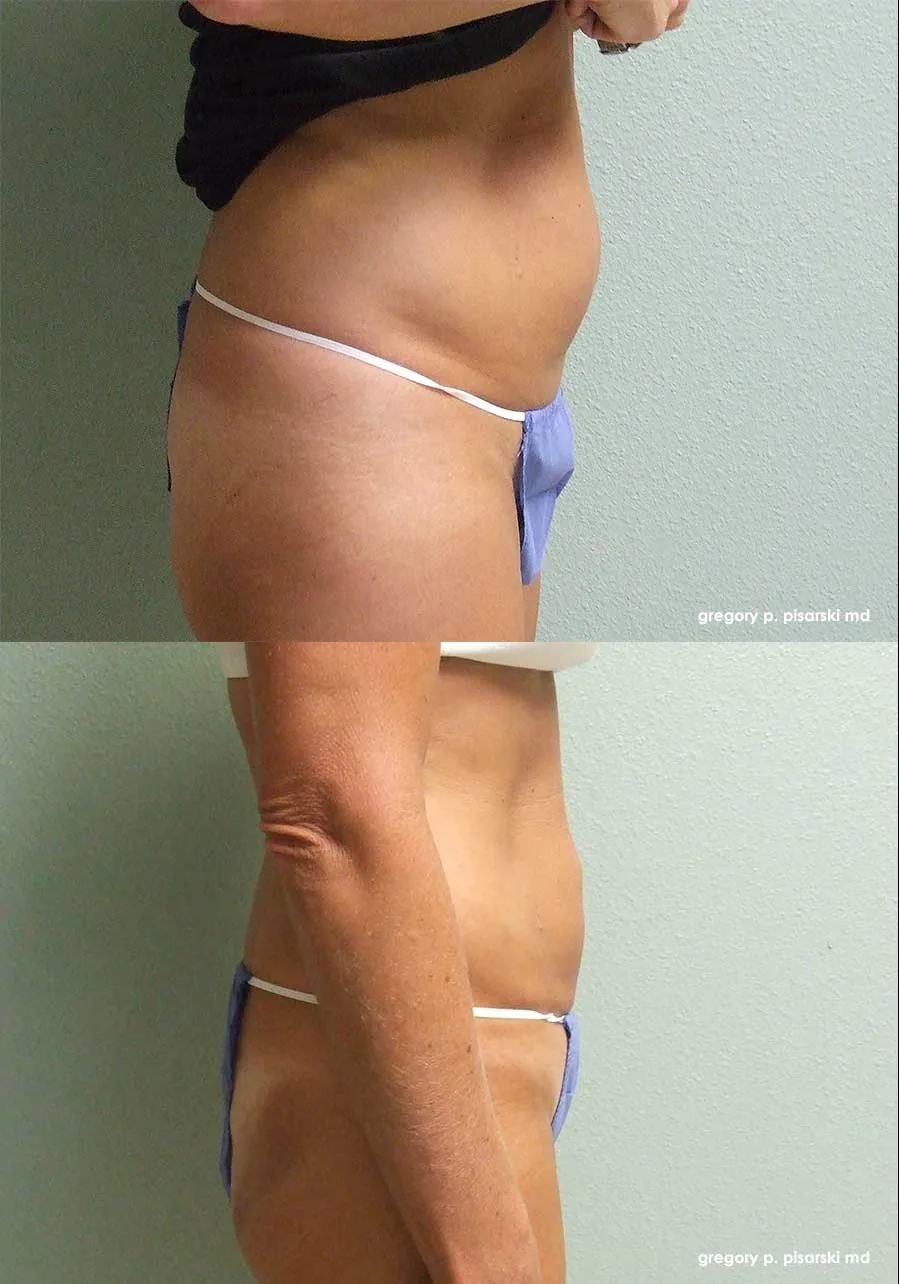 SmartLipo patient