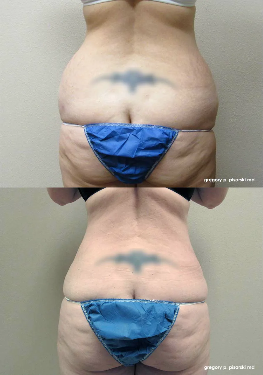 SmartLipo patient