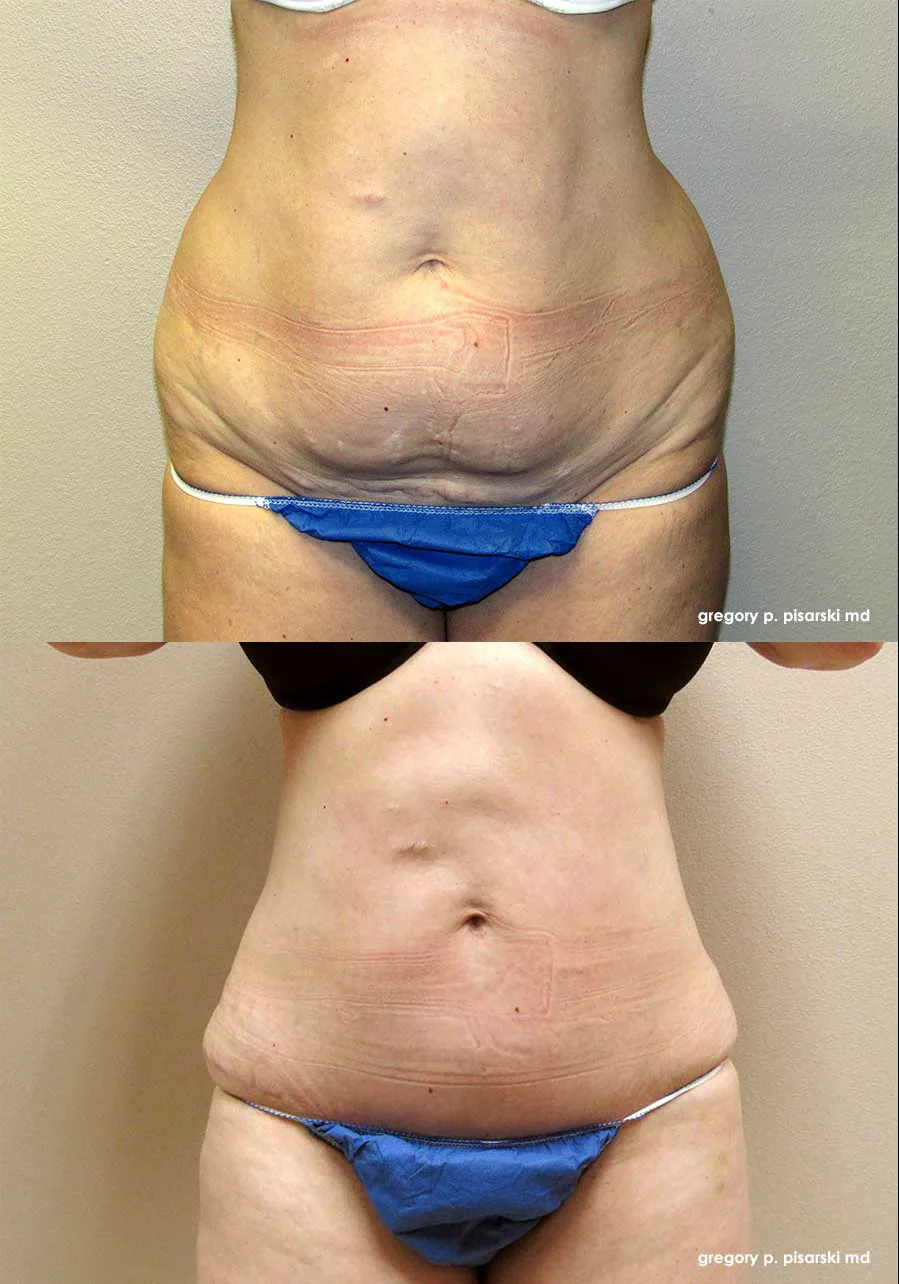 SmartLipo patient