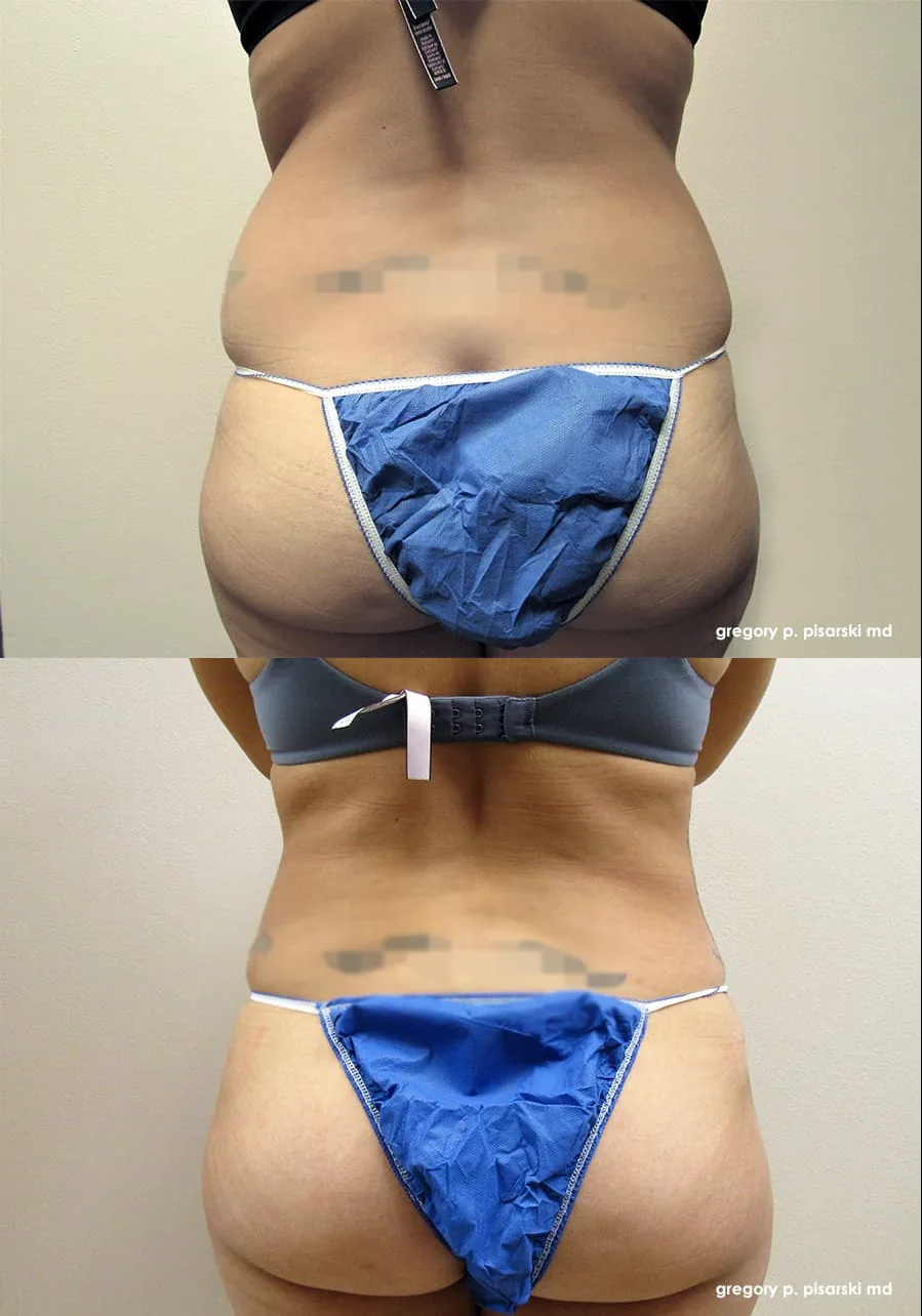 SmartLipo patient