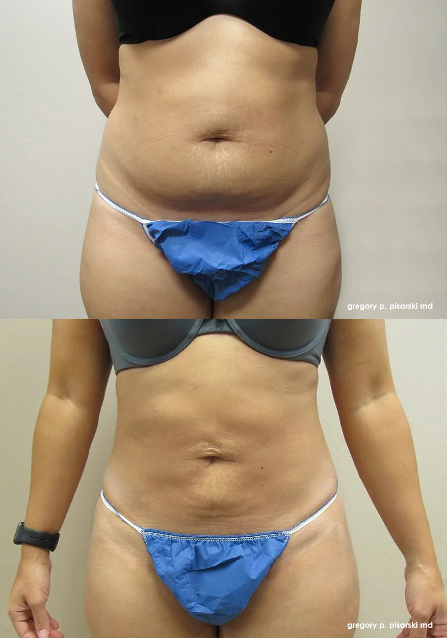 SmartLipo patient