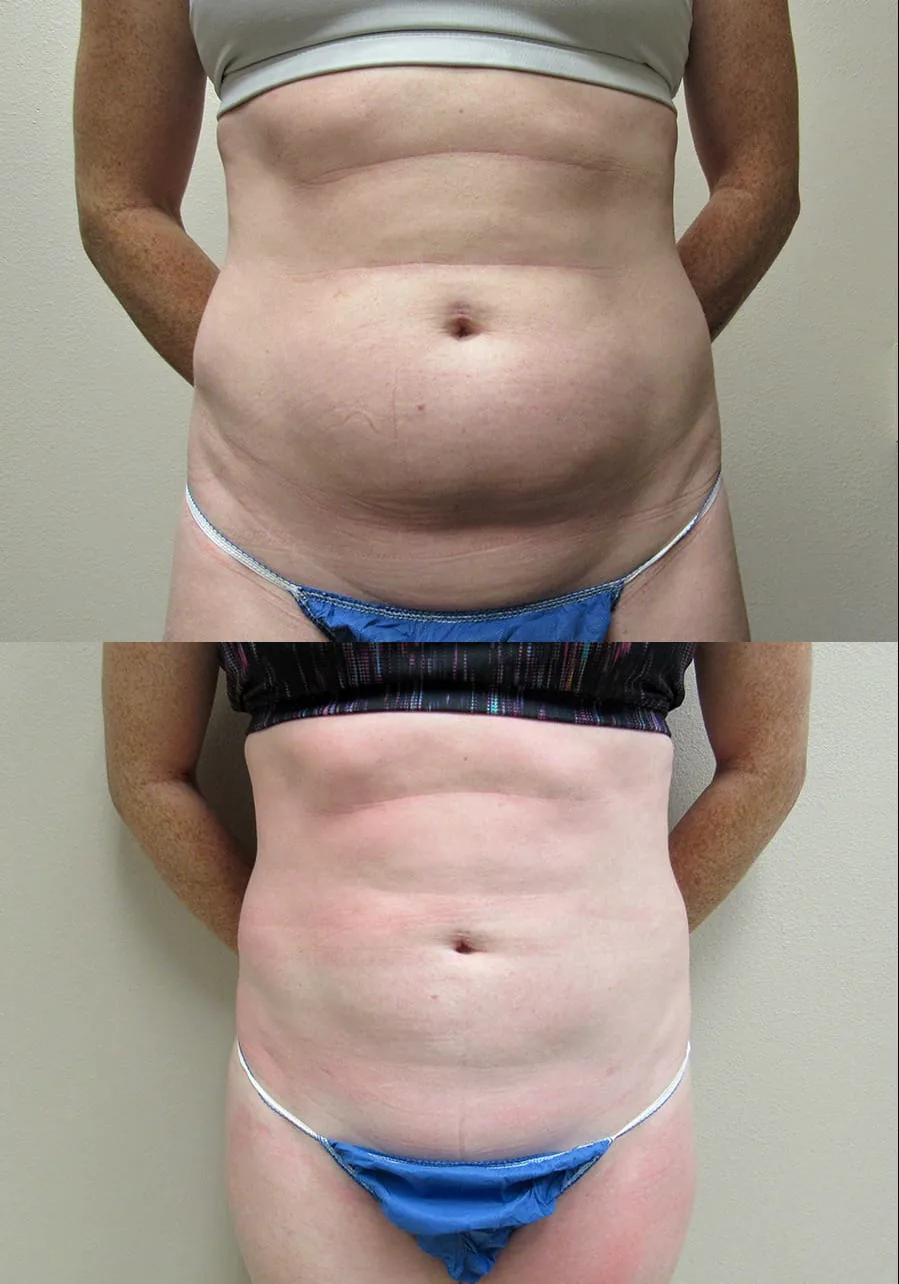 SmartLipo patient