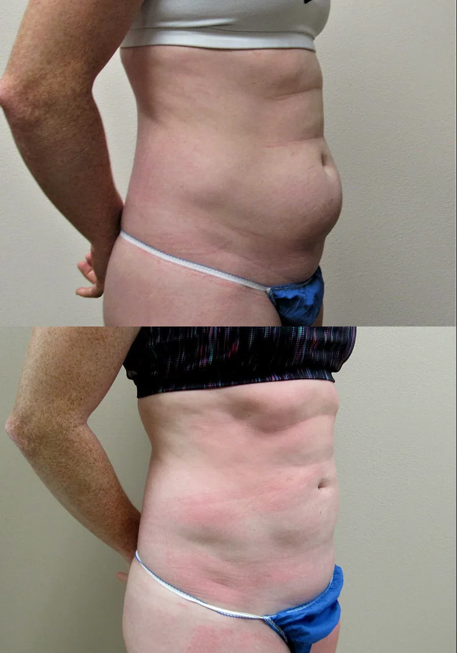 SmartLipo patient