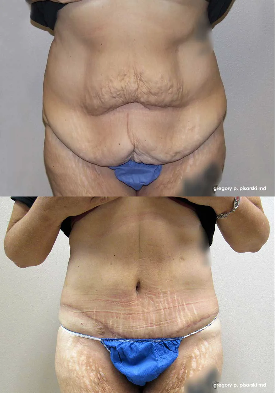 Tummy tuck patient
