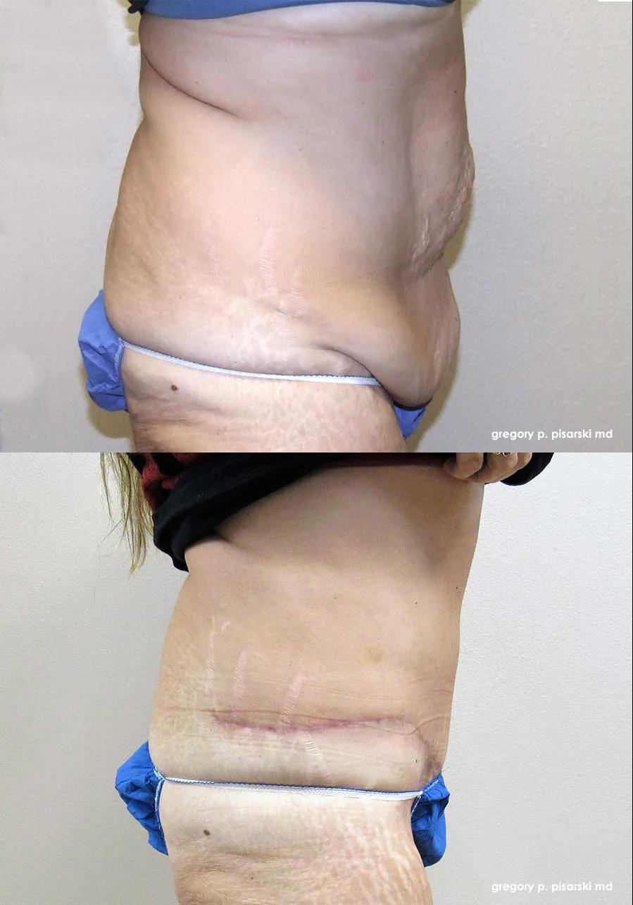 Tummy tuck patient