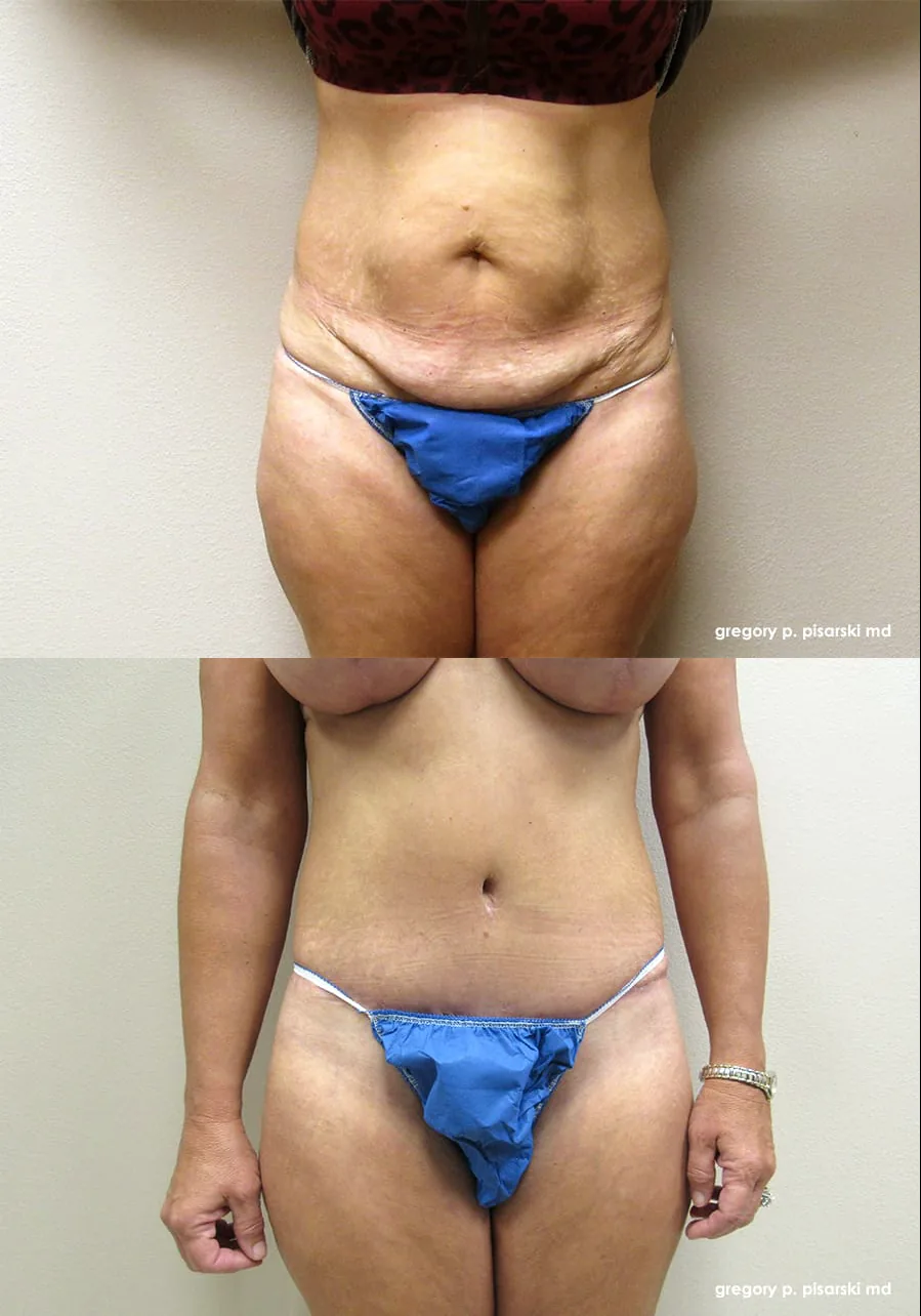 Tummy tuck patient