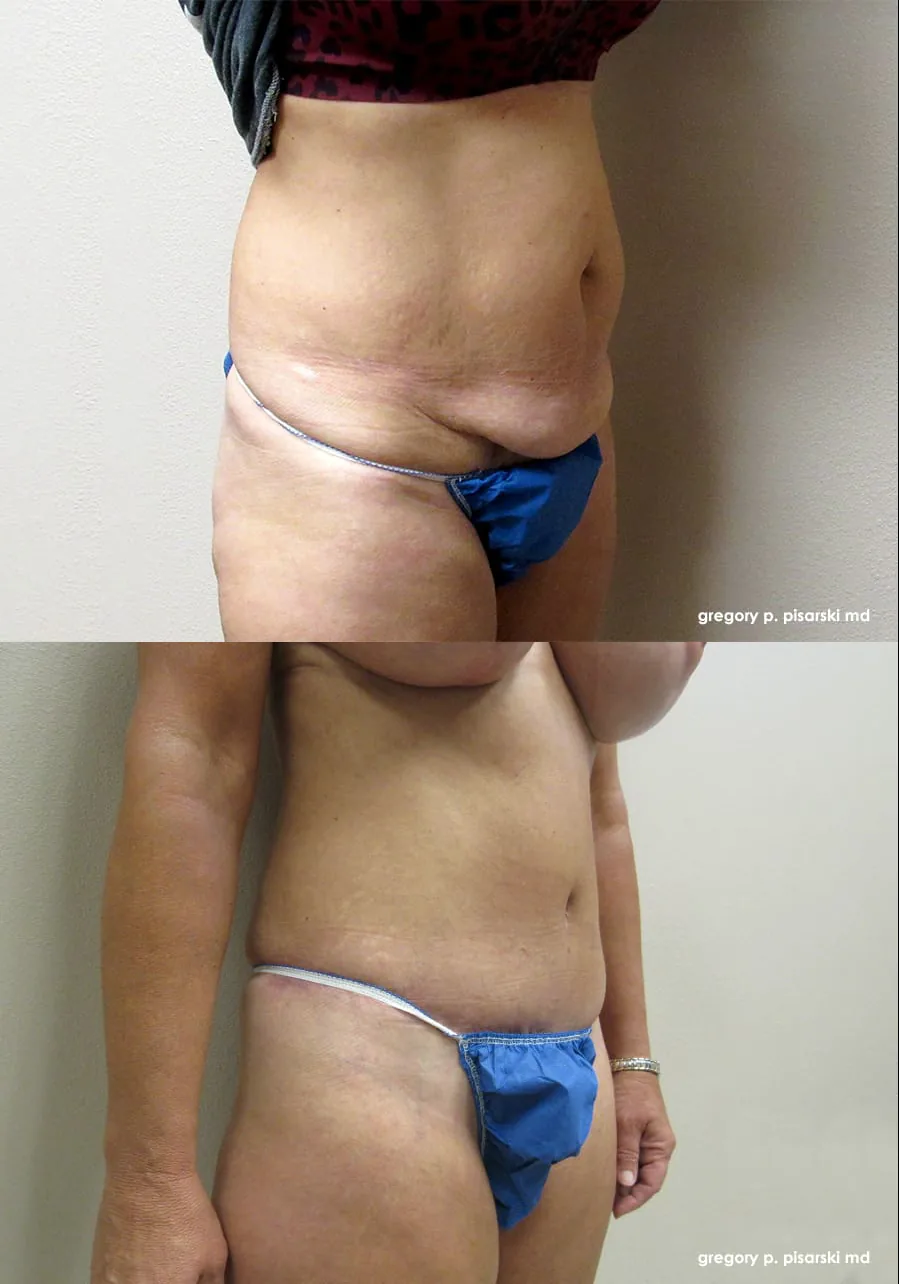 Tummy tuck patient