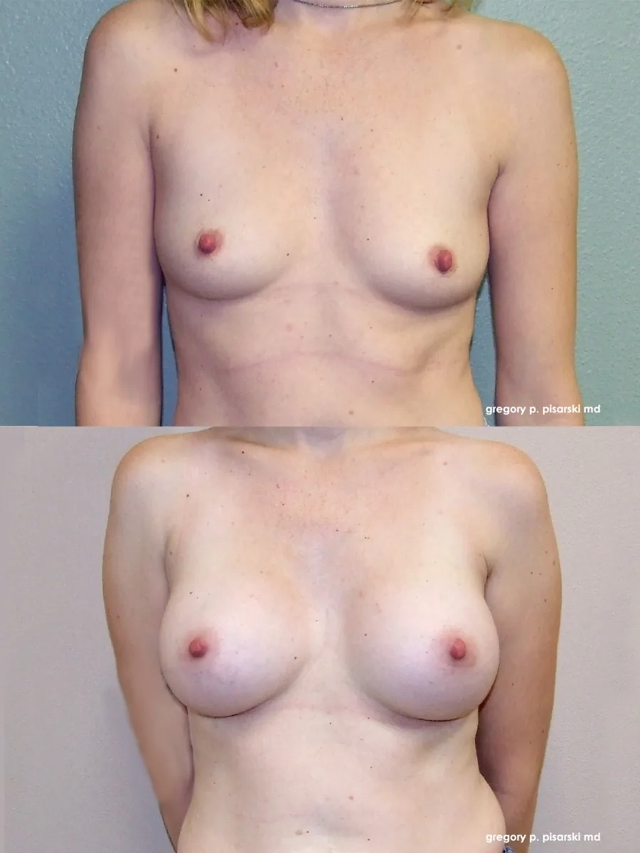 Breast augmentation patient