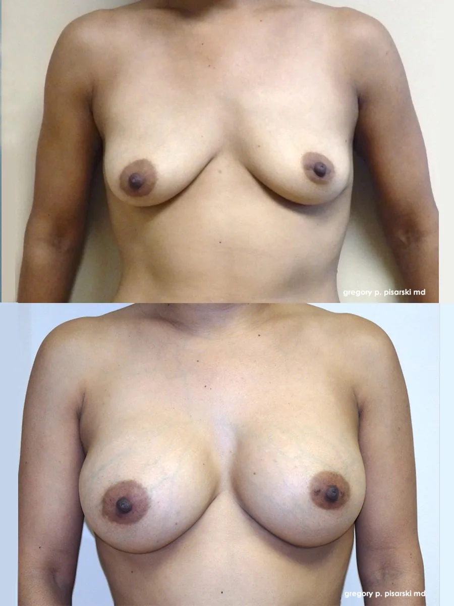 Breast augmentation patient