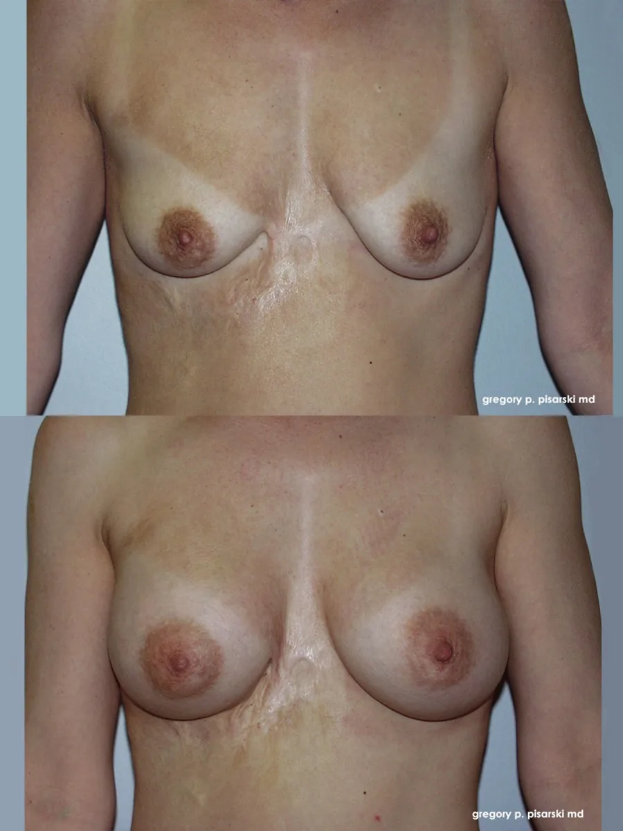 Breast augmentation patient