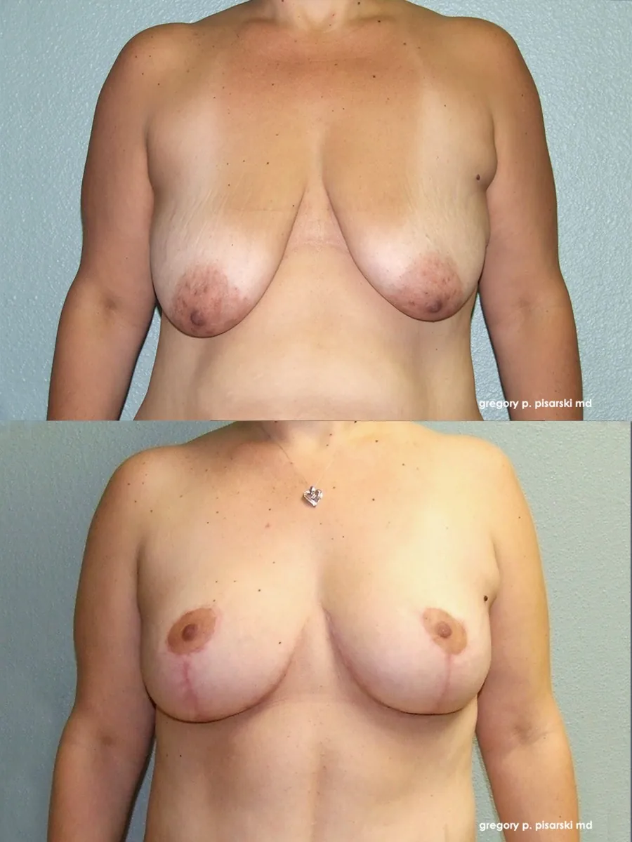 Breast lift patient