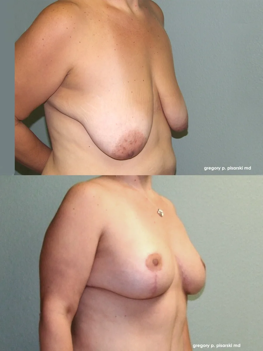 Breast lift patient