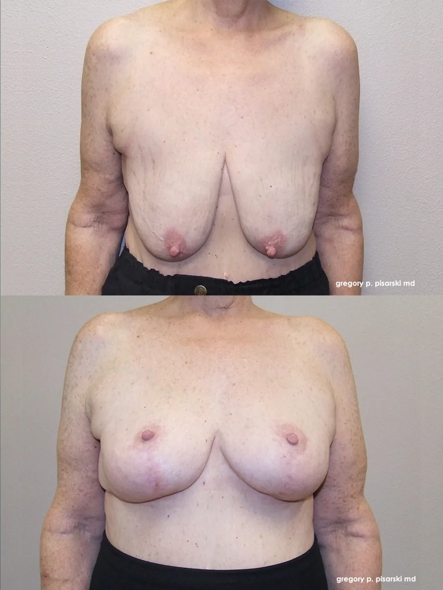 Breast lift patient
