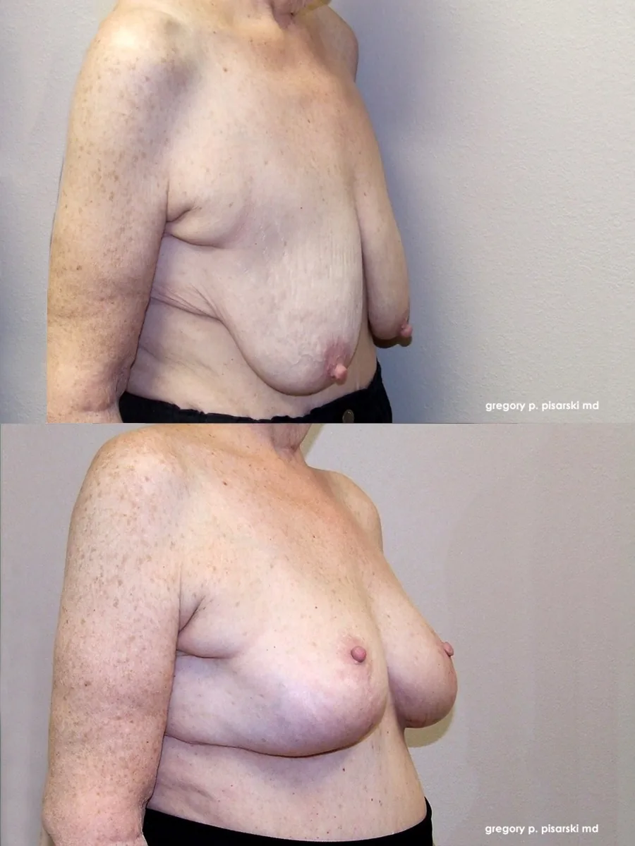 Breast lift patient