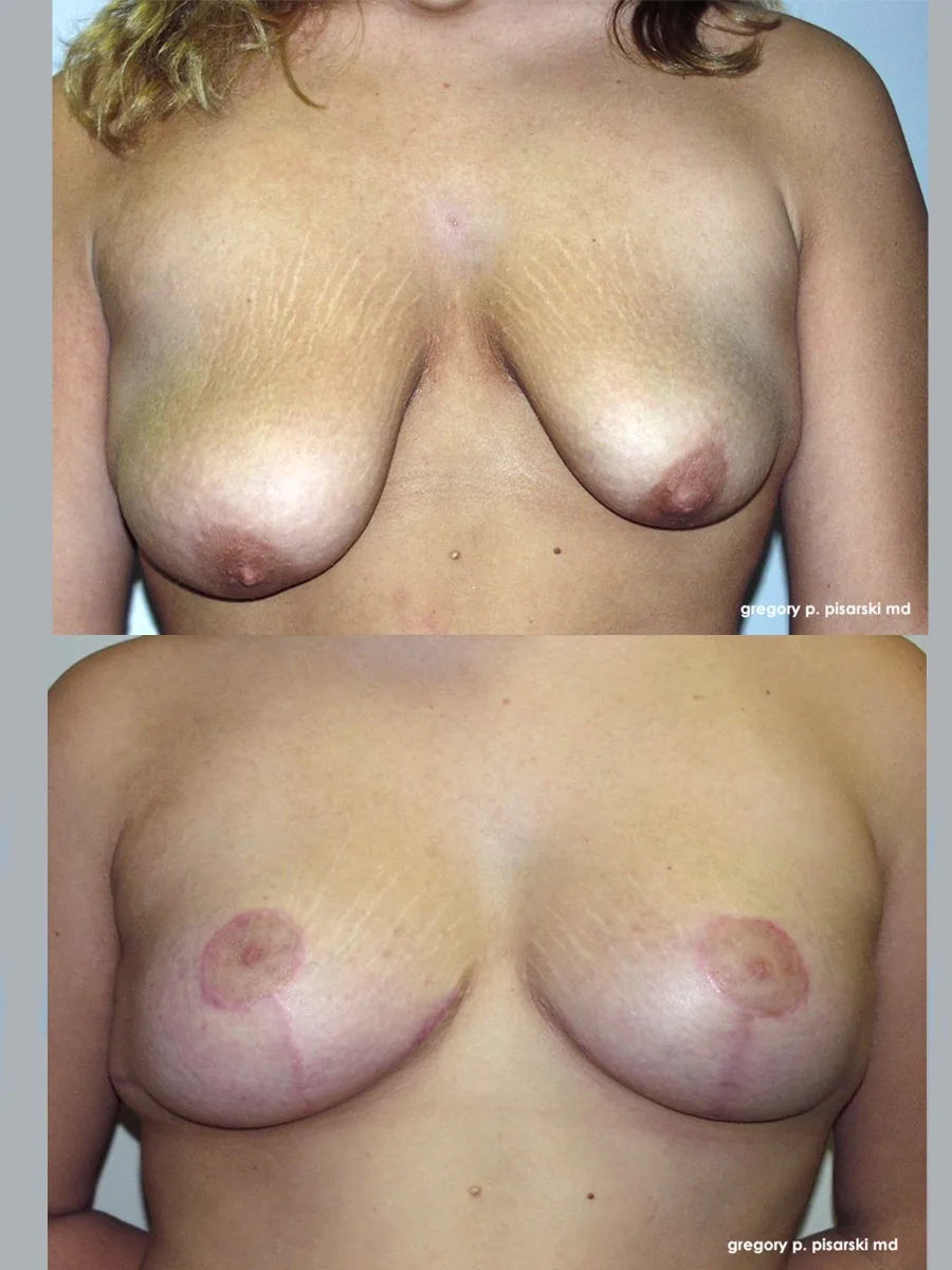 Breast lift patient