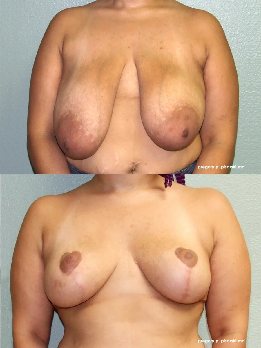 Breast reduction patient