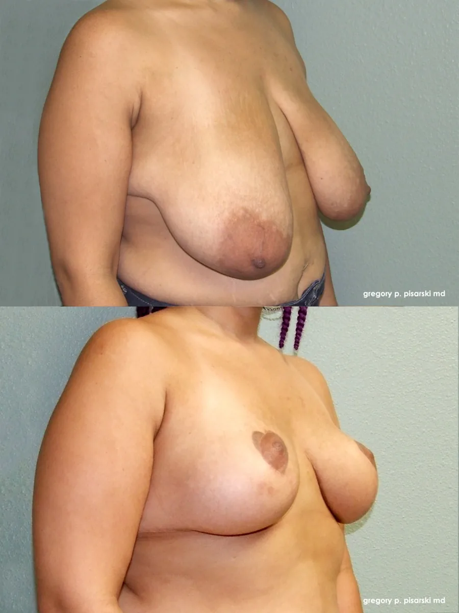 Breast reduction patient