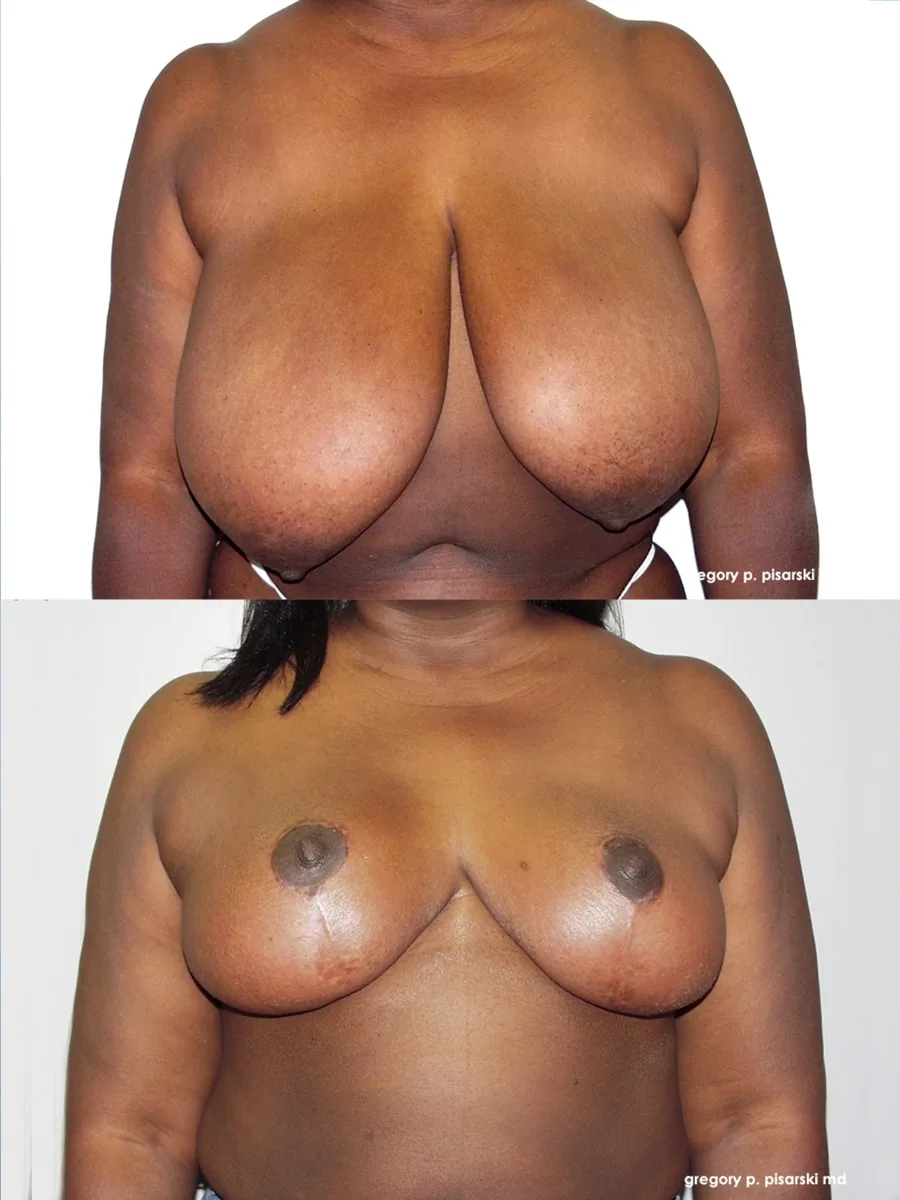 Breast reduction patient