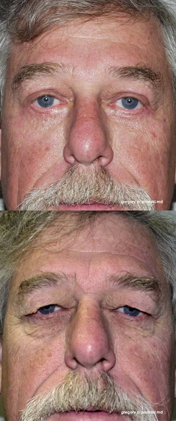 Blepharoplasty patient
