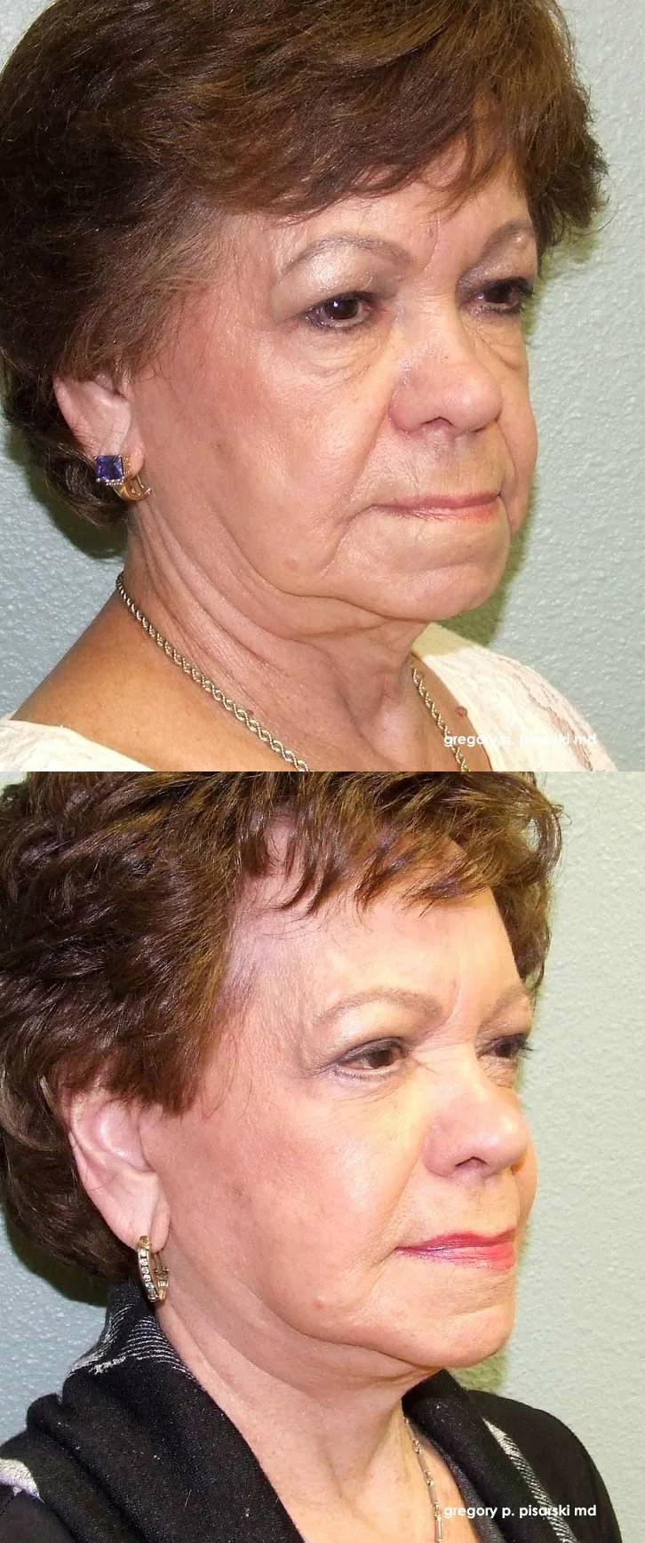 Blepharoplasty patient