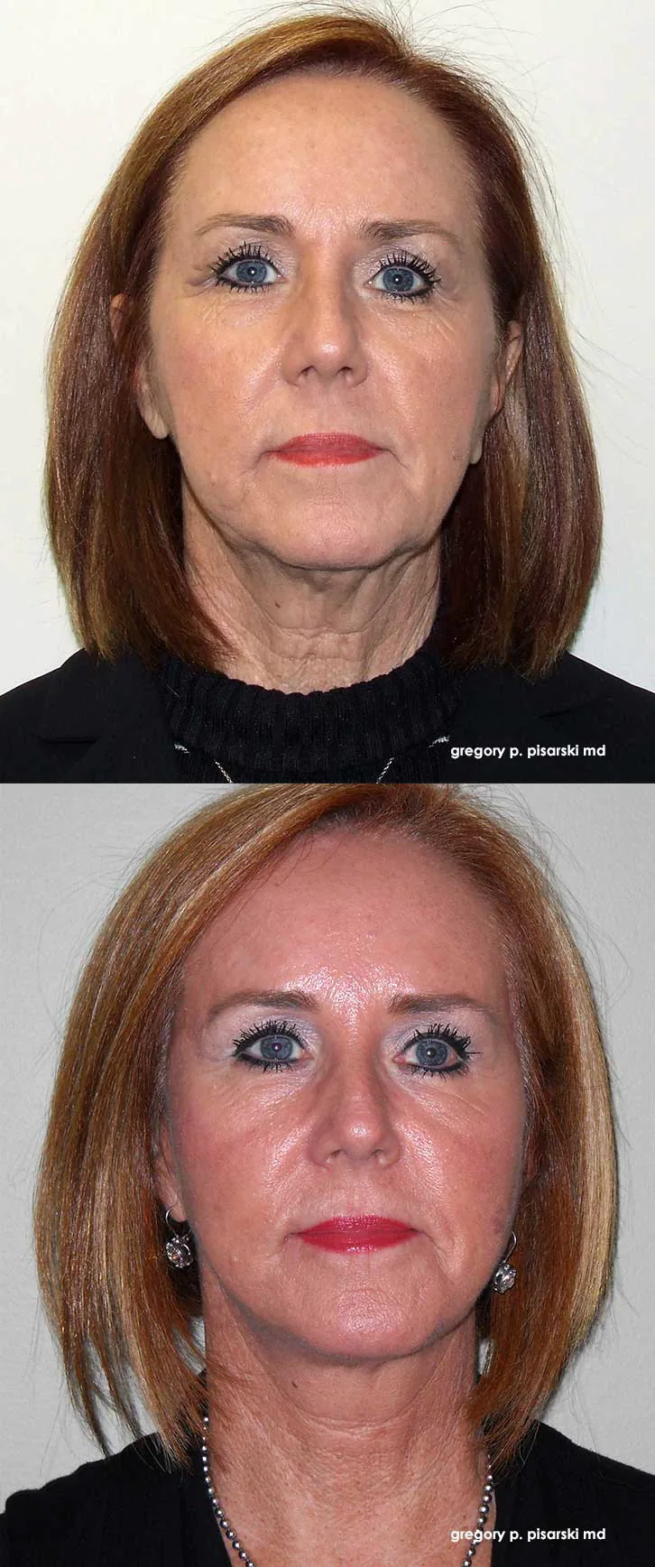 Blepharoplasty patient