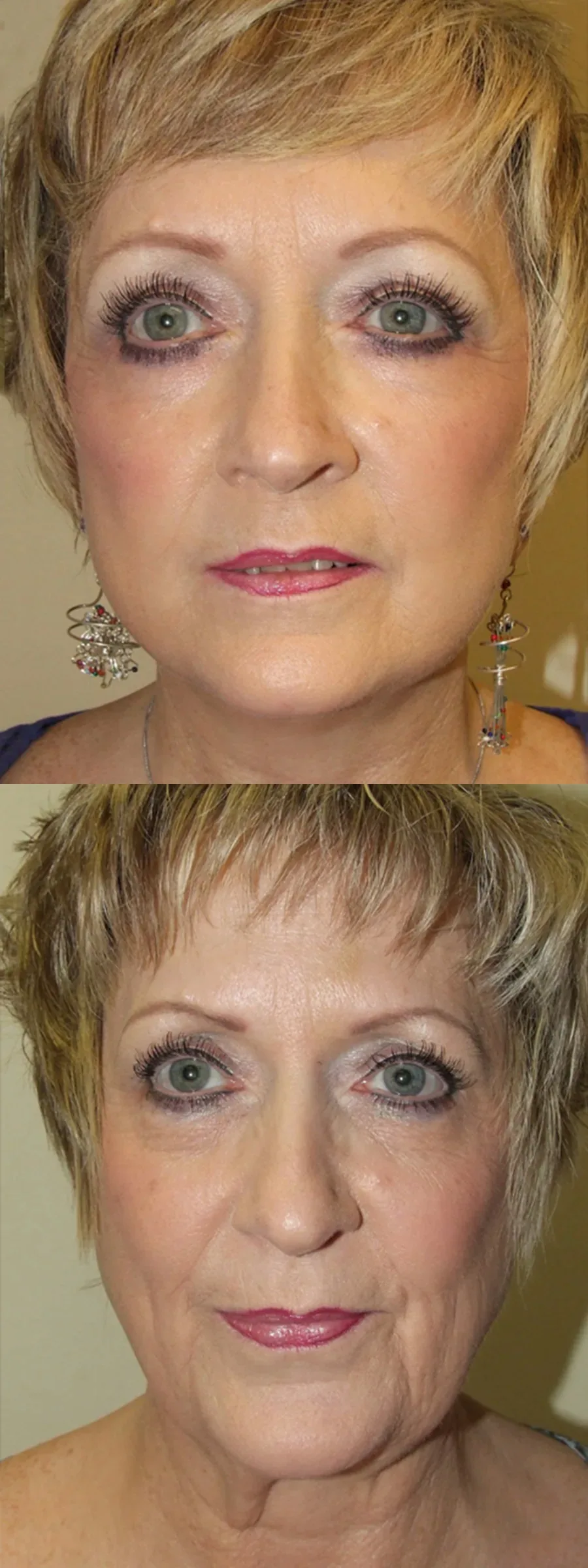 Face lift patient