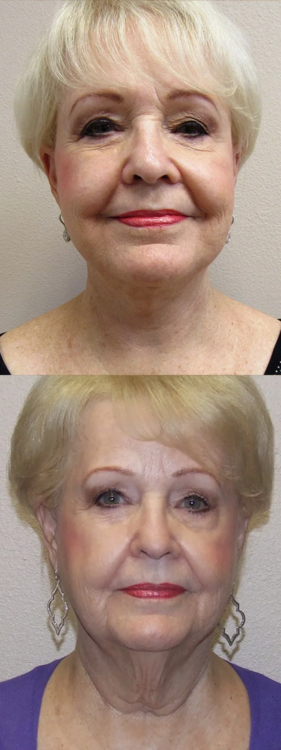 Face lift patient