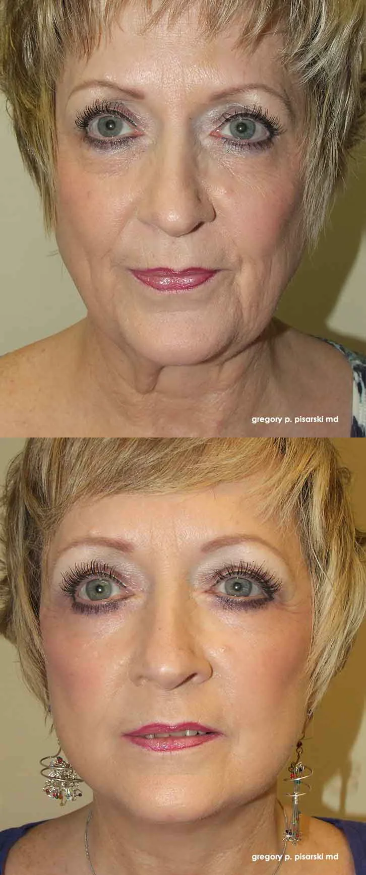 Neck lift patient