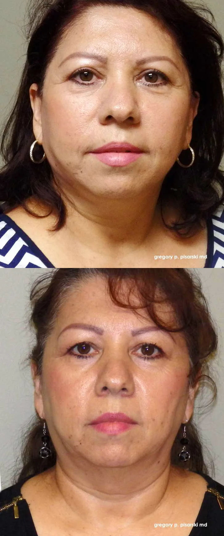 QuickLift patient