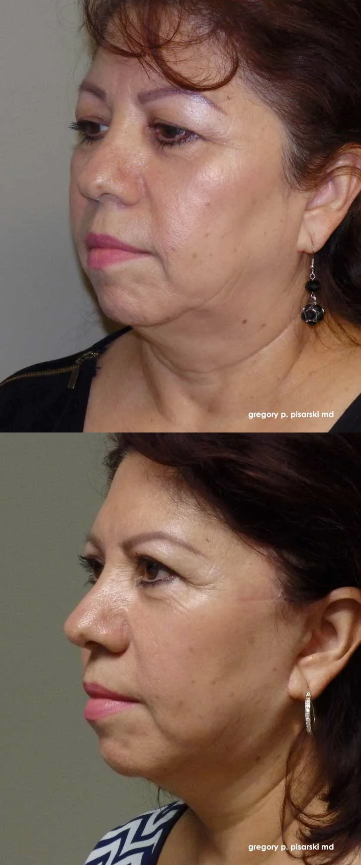 QuickLift patient