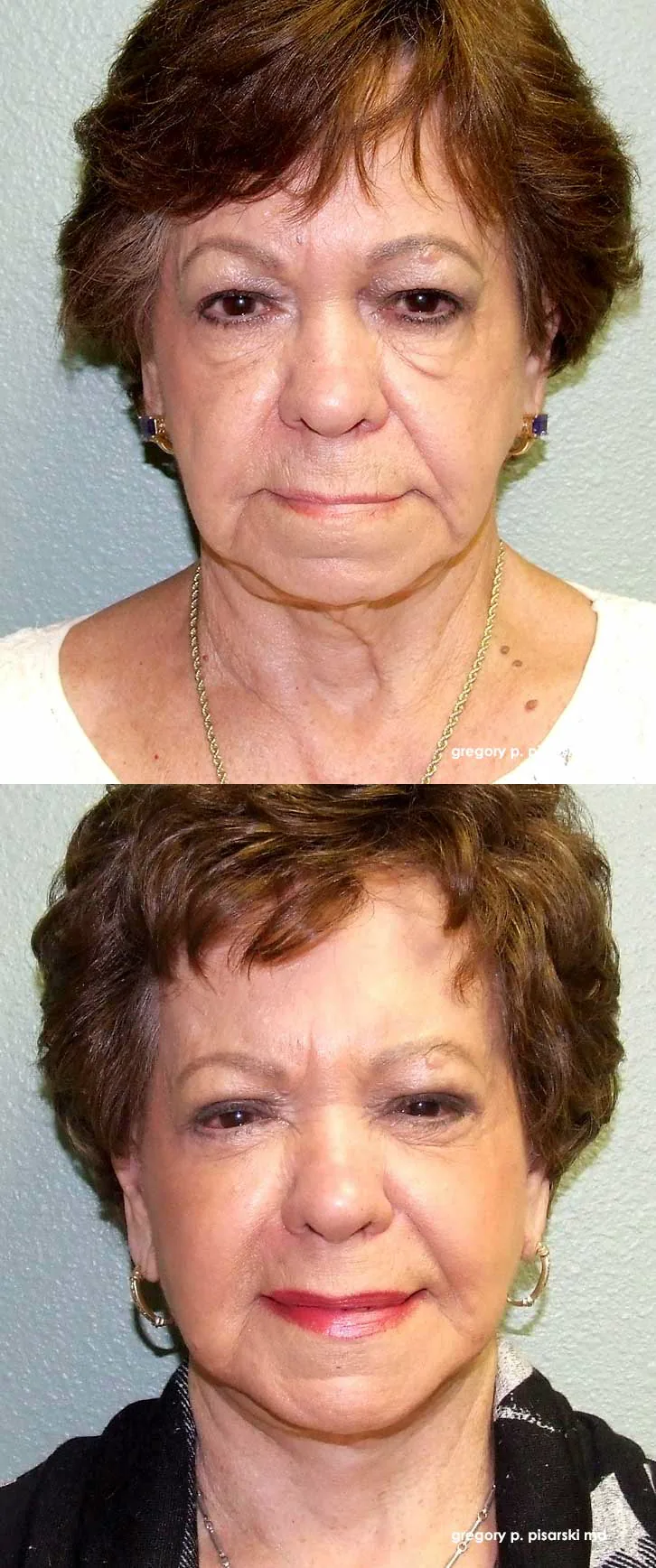 QuickLift patient