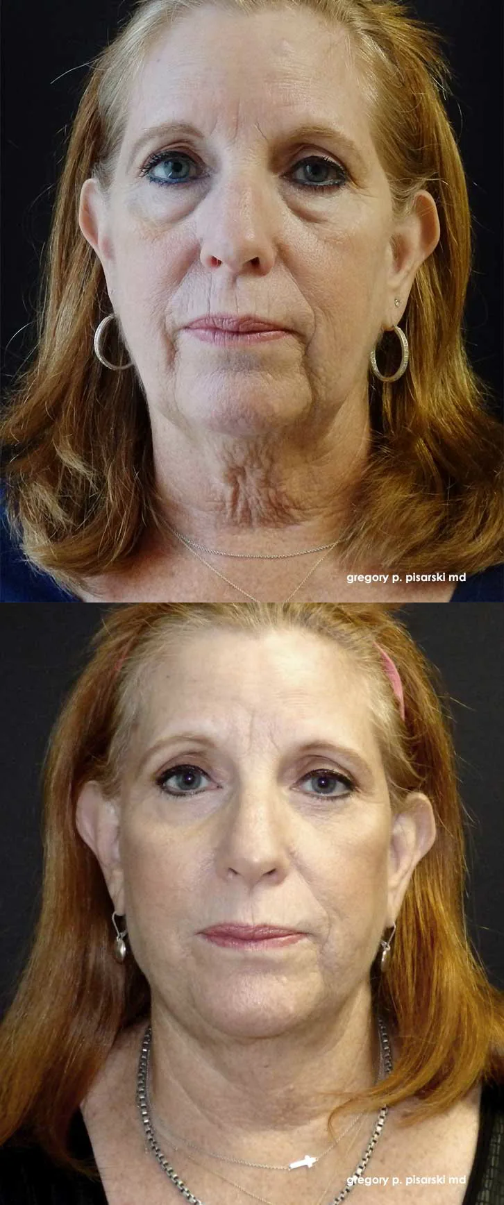 QuickLift patient