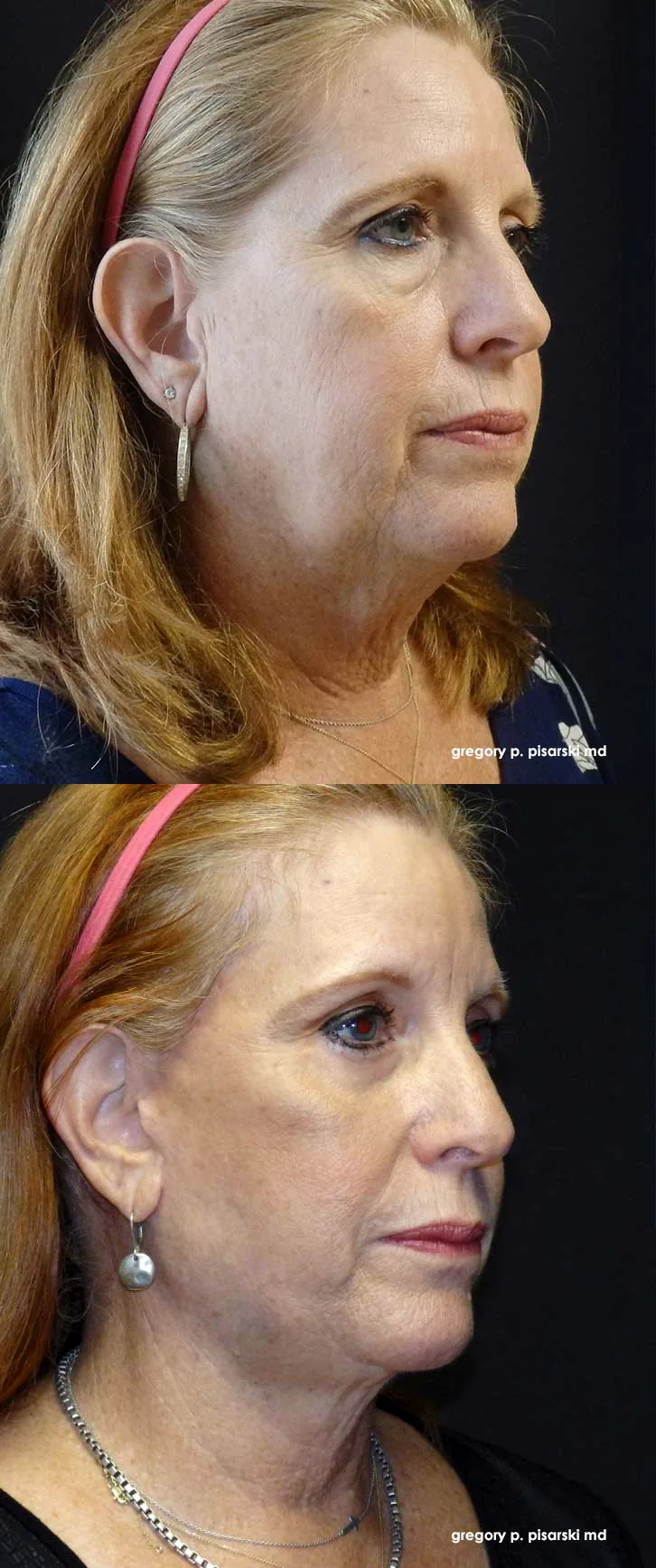 QuickLift patient