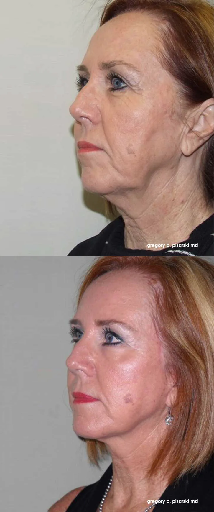 QuickLift patient