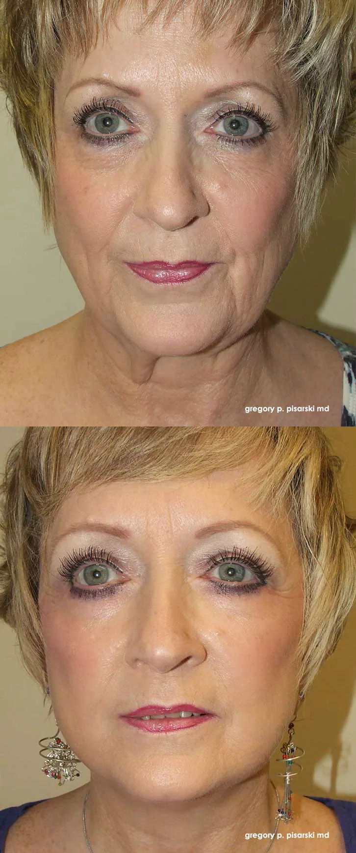 QuickLift patient