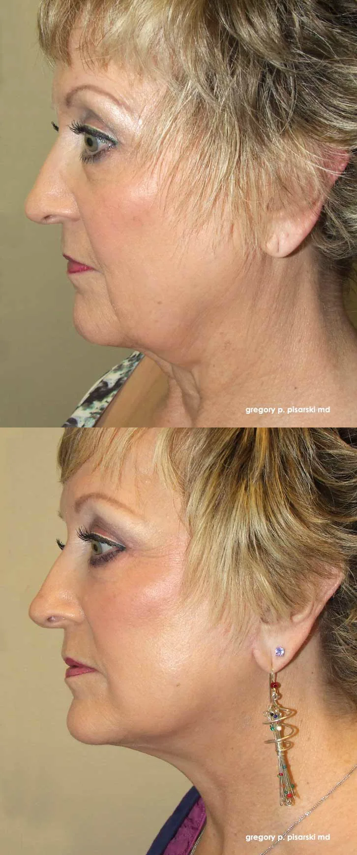 QuickLift patient