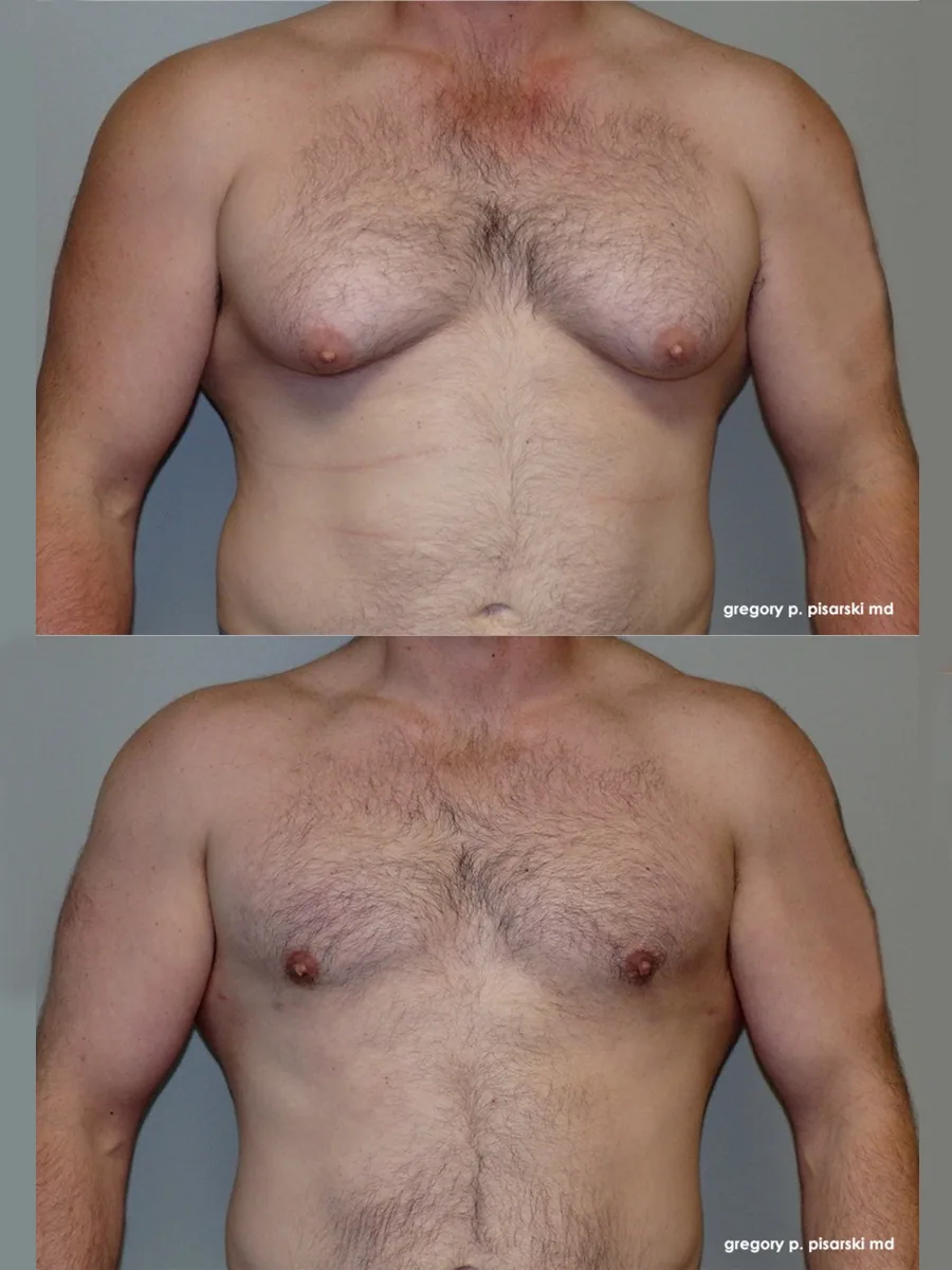 Gynecomastia patient