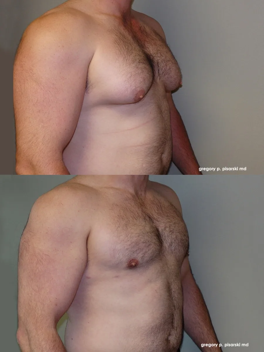 Gynecomastia patient