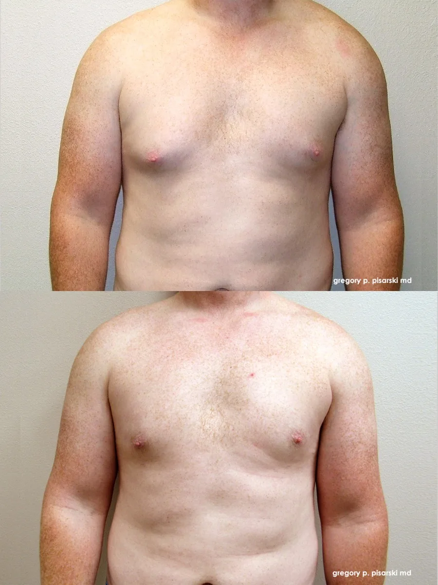 Gynecomastia patient