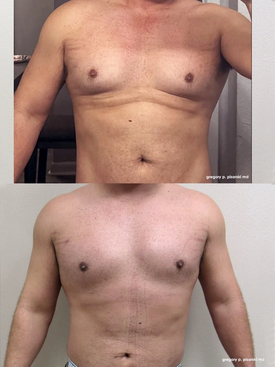 Gynecomastia patient