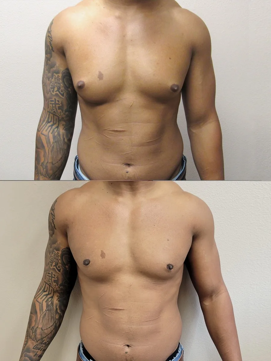 Gynecomastia patient